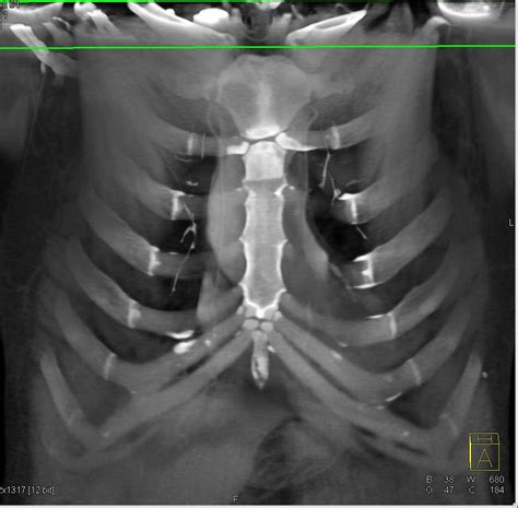 chest compression sternum fracture test|sternum fracture bruising.